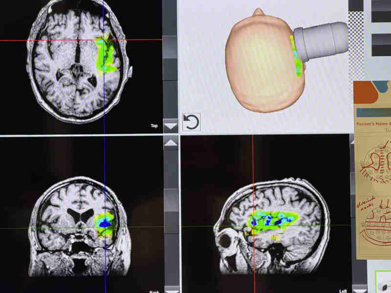 Transkranielle Pulsstimulation Behandlung in Anwendung am Patienten